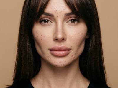 Портрет с прыщами: генерация фото лиц с акне и несовершенствами онлайн