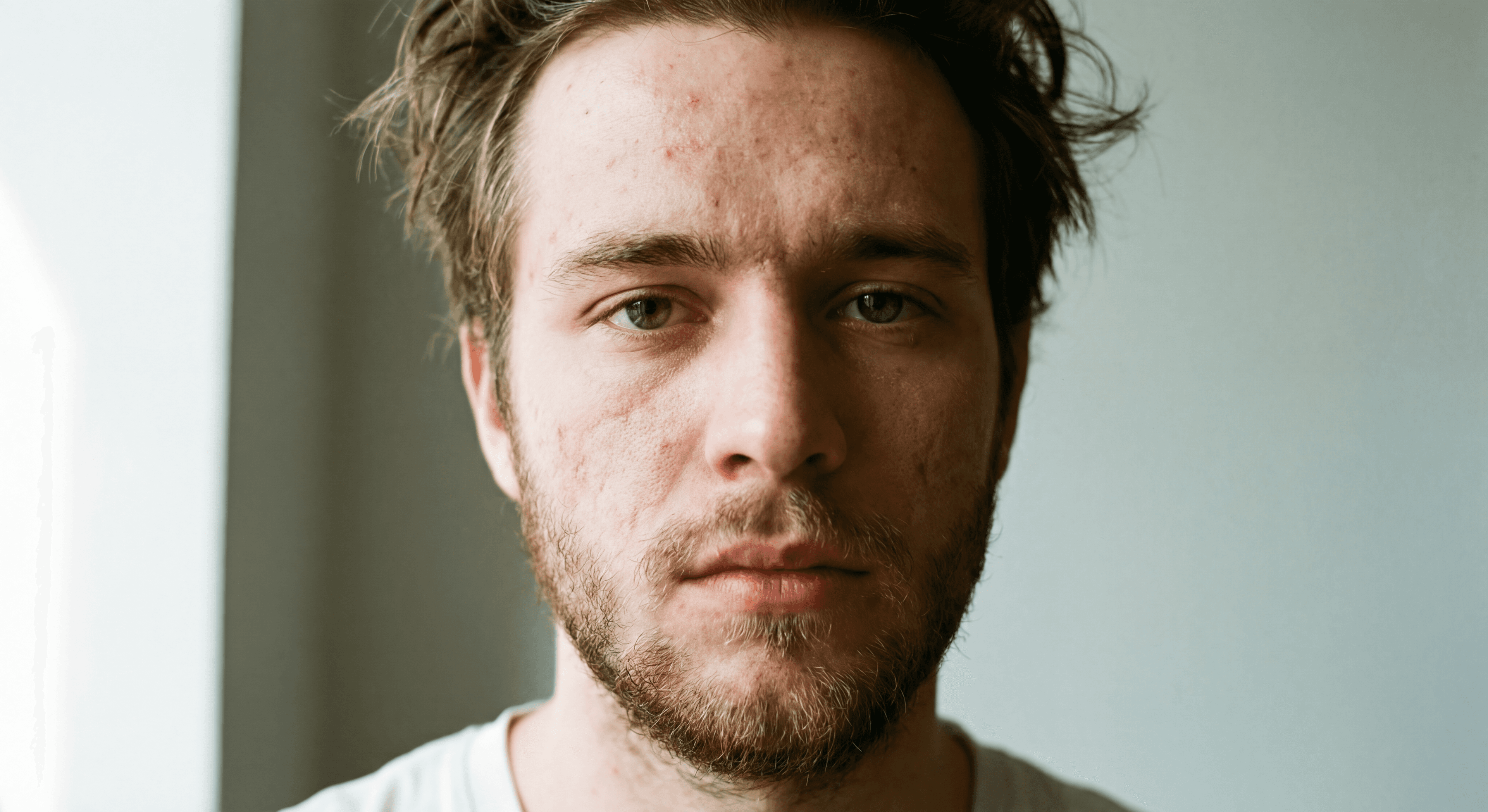 Портрет с прыщами